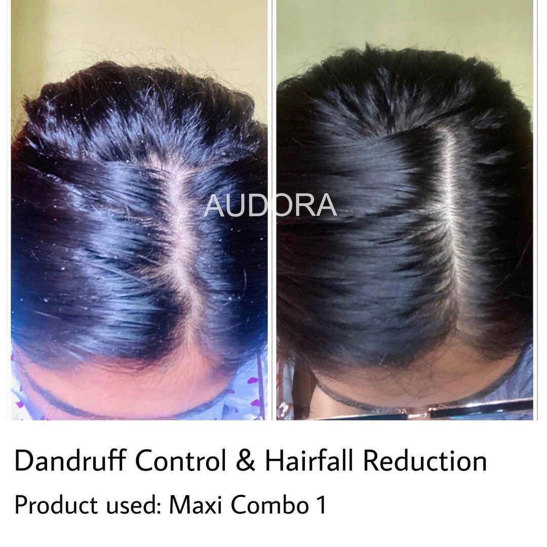 Combo 1 Hair Fall Control | Anti-Dandruff